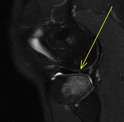 Figure 2 for case Lateral meniscus flap tear and adjacent stress fracture